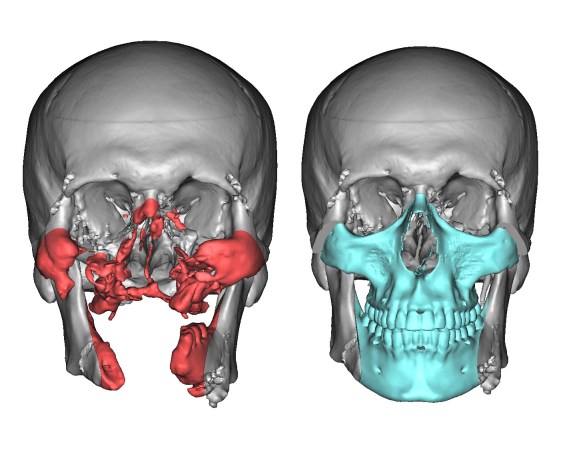 How 3D technology is revolutionizing face transplants