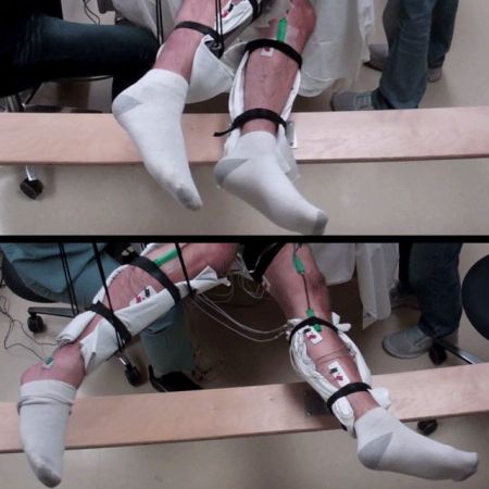 New Treatment Lets Paralyzed Patients Move Their Legs