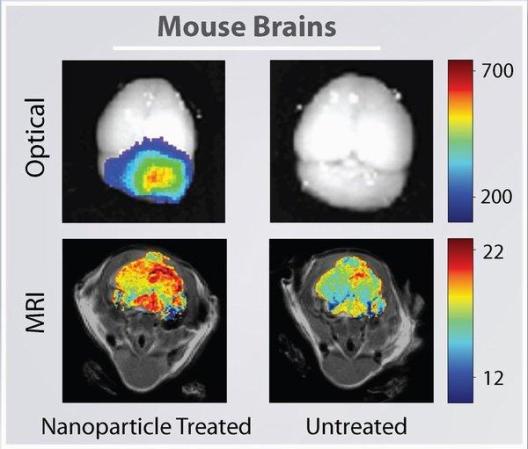 Scientists Paint Brain Tumors With Nanoparticles for More Precise Removal