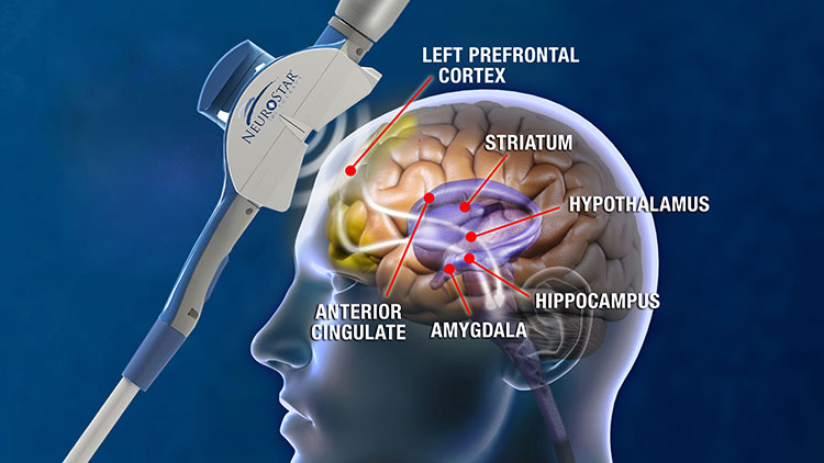 Magnetic Brain Stimulation May Trump Drugs For Severe Depression