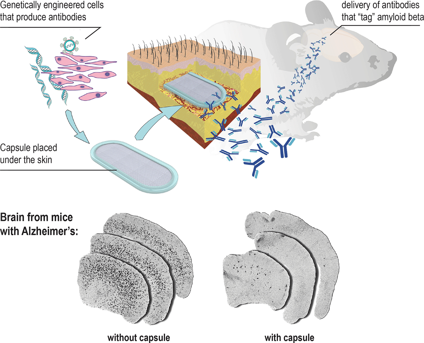 Skin implant to combat Alzheimer's