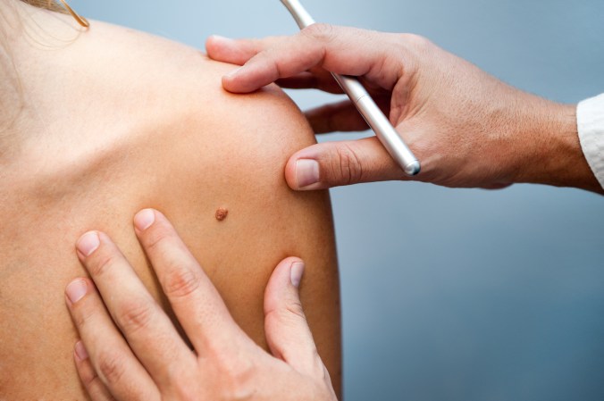 Checking yourself for melanomas? You might not be looking for the right thing.