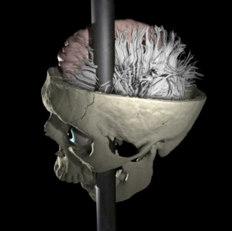 Phineas Gage, Neurology’s Most Interesting Case, Gets His Head Re-Examined With a New Neural Map