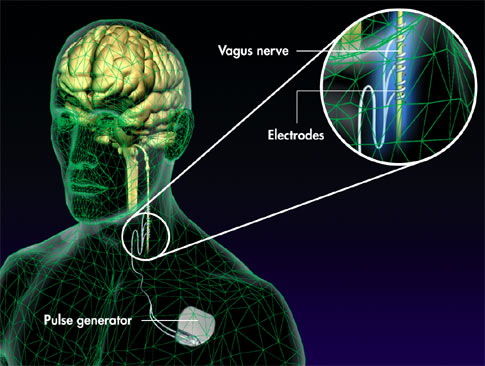 Brain Pacemaker