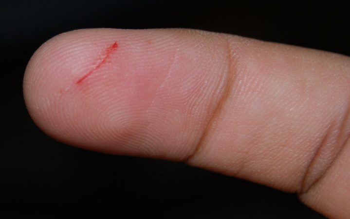 Why do paper cuts hurt so much?