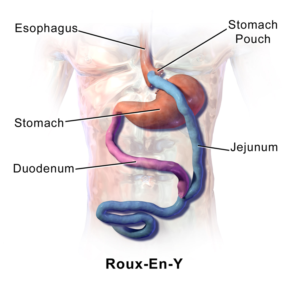 gastric bypass