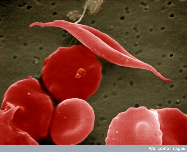 sickle cell