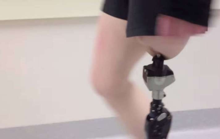 Approved: Prosthetic Legs That Anchor Directly To The Bone