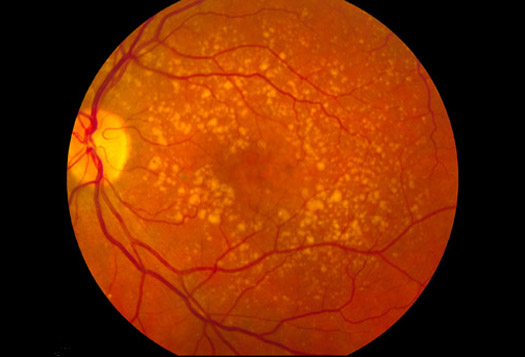 Scientists Morph Human Skin Cells Into Retinal Cells