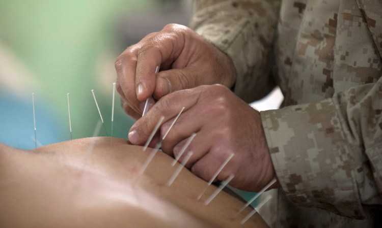 Acupuncture May Work Like Drugs To Relieve Stress