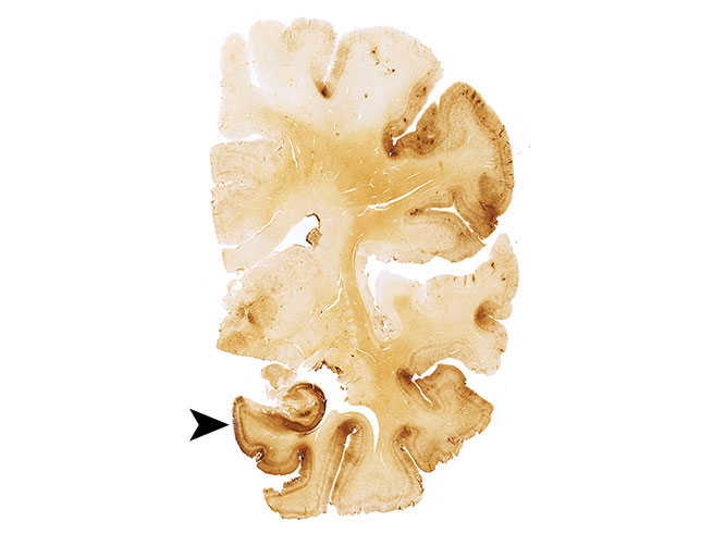 CTE in a former football players' brain