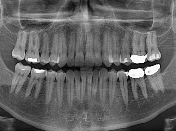 The End Of Root Canals?