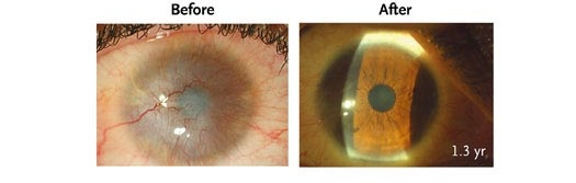 Stem Cells Shown to Restore Sight To Eyes Damaged By Burns