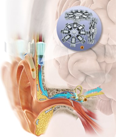 An Artificial Inner Ear To Eliminate Vertigo