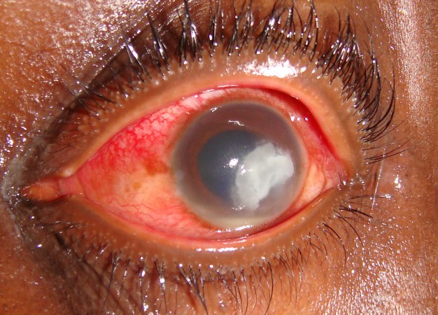 microbial keratitis