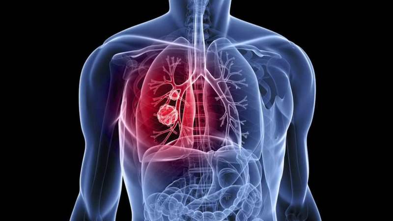 Convincing Lung Cancer To Commit Suicide