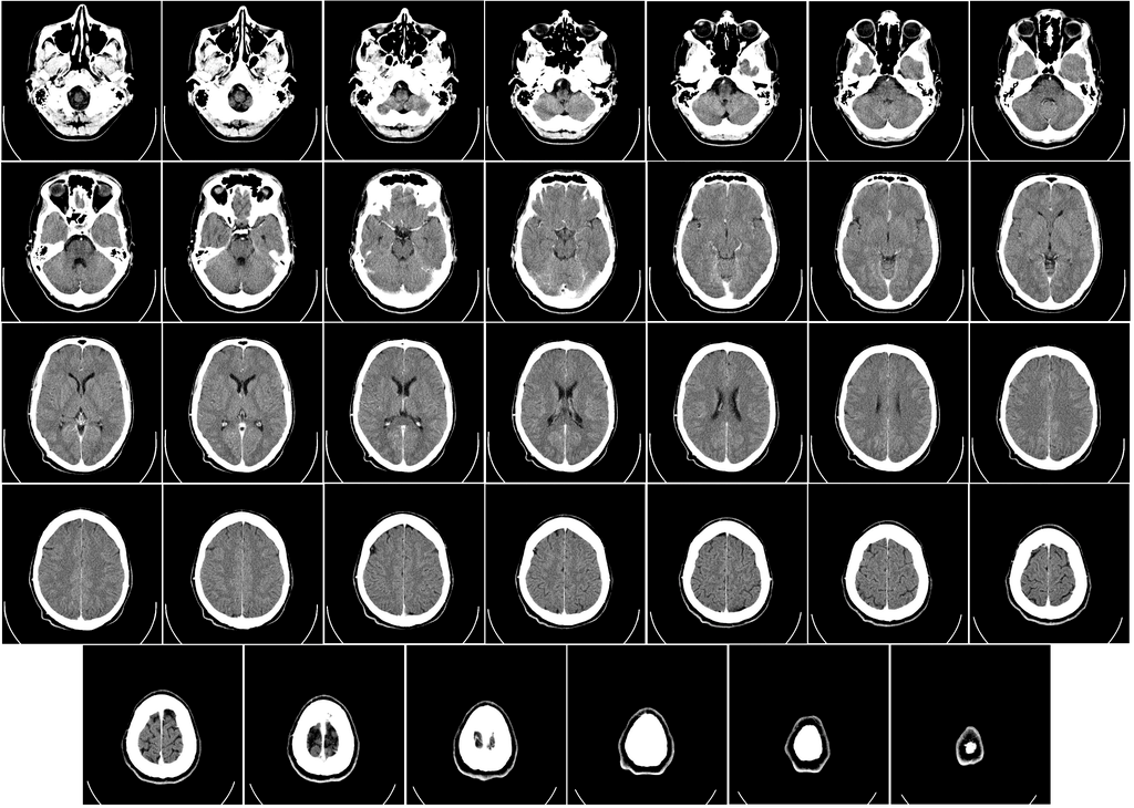 CT scan brain