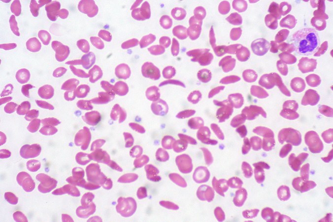 What is sickle cell disease?