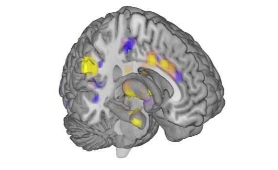 Brain Scans Offer Precise Measurement Of Human Pain