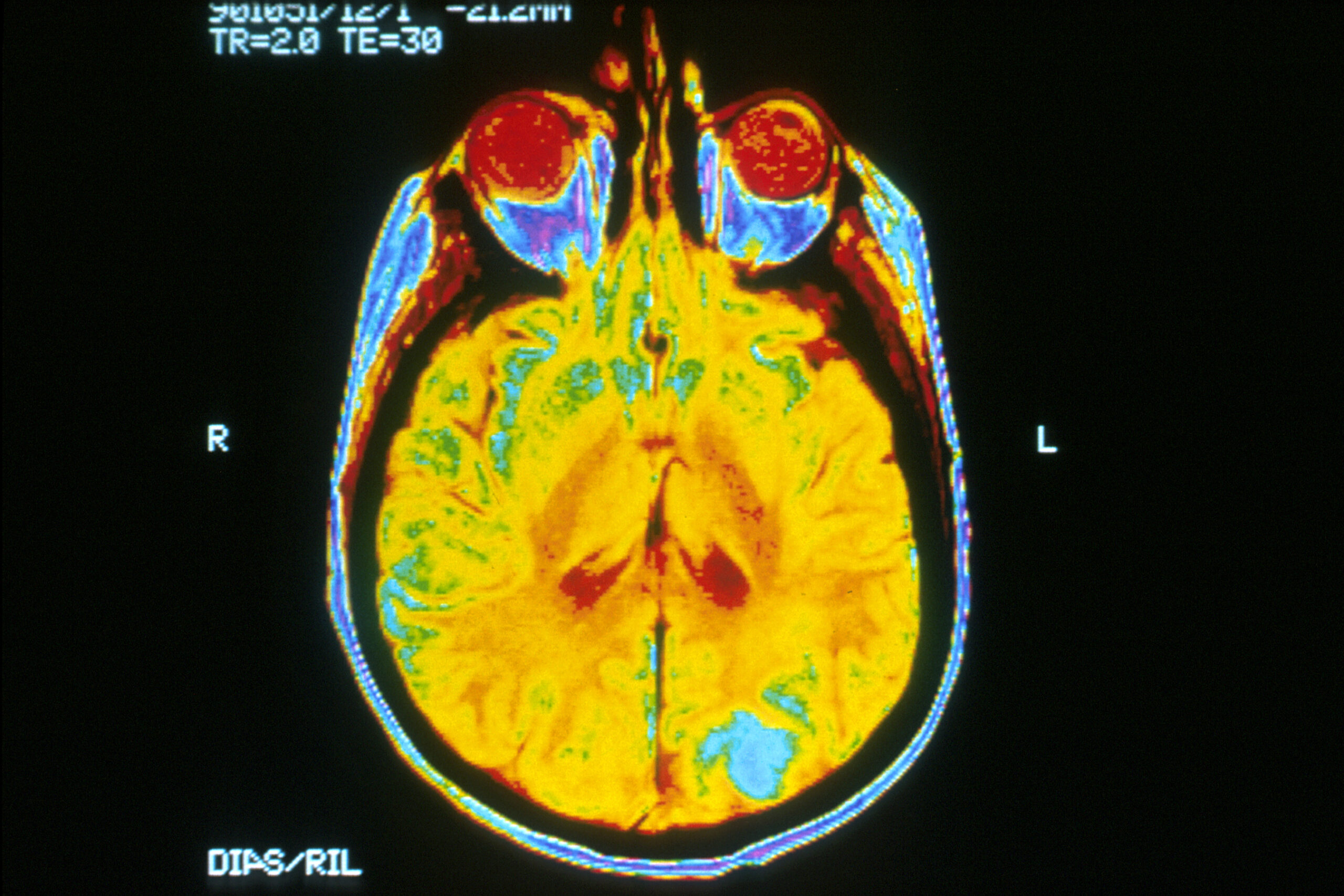 Largest-Ever Medical Imaging Study Launches In The UK