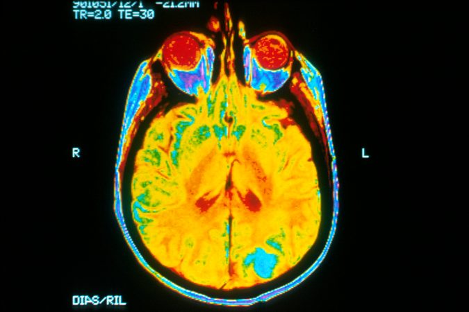 Largest-Ever Medical Imaging Study Launches In The UK