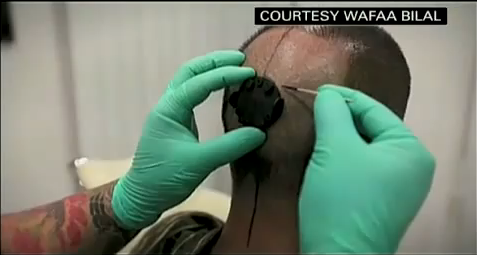 Video: Professor Surgically Installs Camera In Head, Starts Tracking the World Behind Him