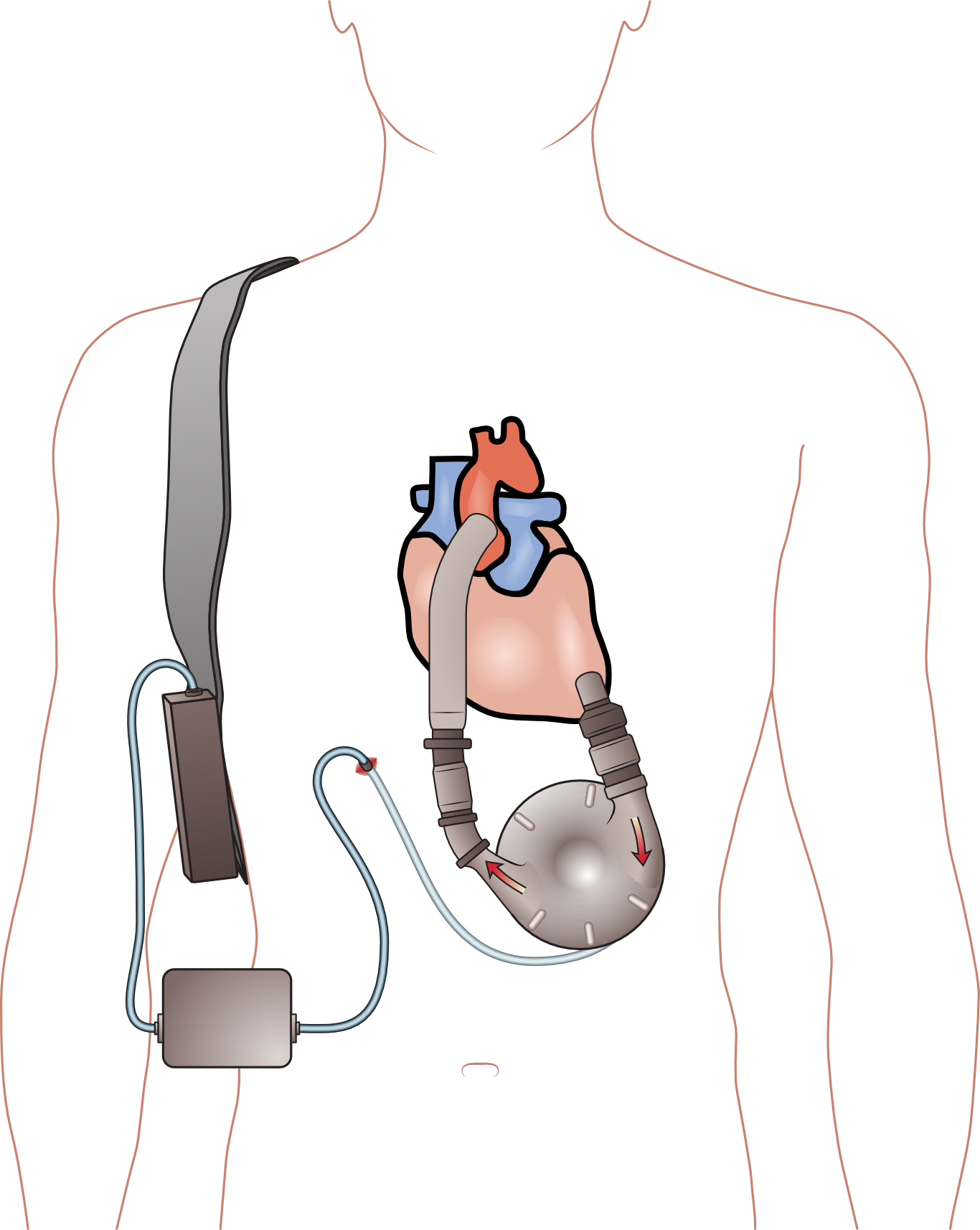 ventricular assist device