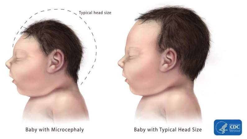 The CDC Has Confirmed Zika Causes Microcephaly Birth Defects