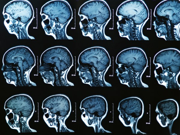 Concussions make lasting changes to the brain, even after you feel fine