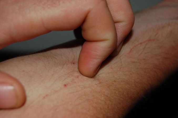 Why Does A Fly Landing On Your Arm Make You Itch?