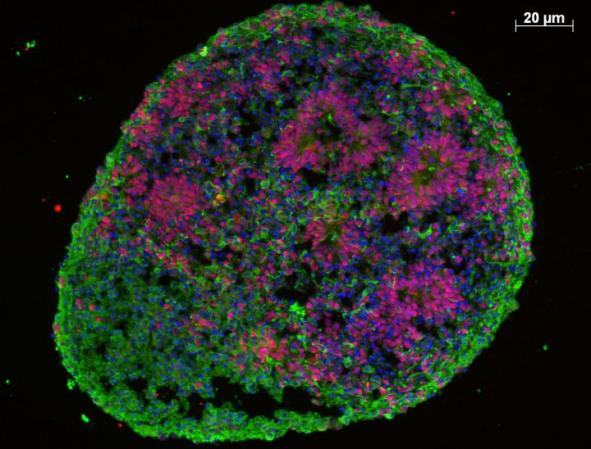 Growing Micro-Brains From Skin Cells Sheds Light On Autism