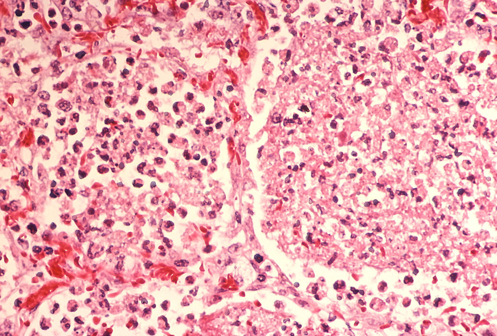 Biopsy of a lung infected by Legionella bacteria
