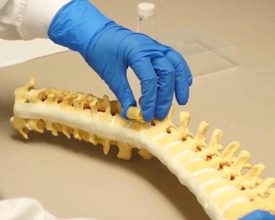 Spongy Implants Can Replace Cancerous Vertebrae