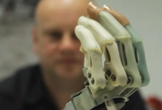 Patient Elects to Have Hand Amputated to Make Way for a Bionic One