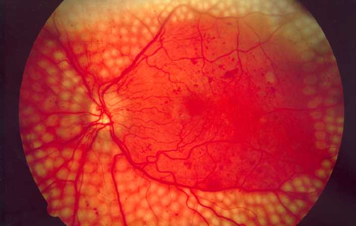 Google is using its deep learning tech to diagnose disease