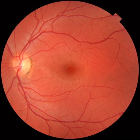 Retina