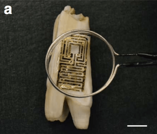 Tattooing Teeth With Graphene Could Warn of Bacteria and Dental Decay