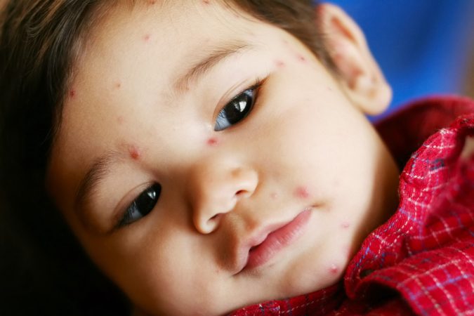 The chickenpox vaccine keeps kids safe from more than just itchy red spots