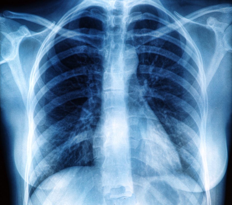 Poor lung cancer screening guidelines miss too many African American ...