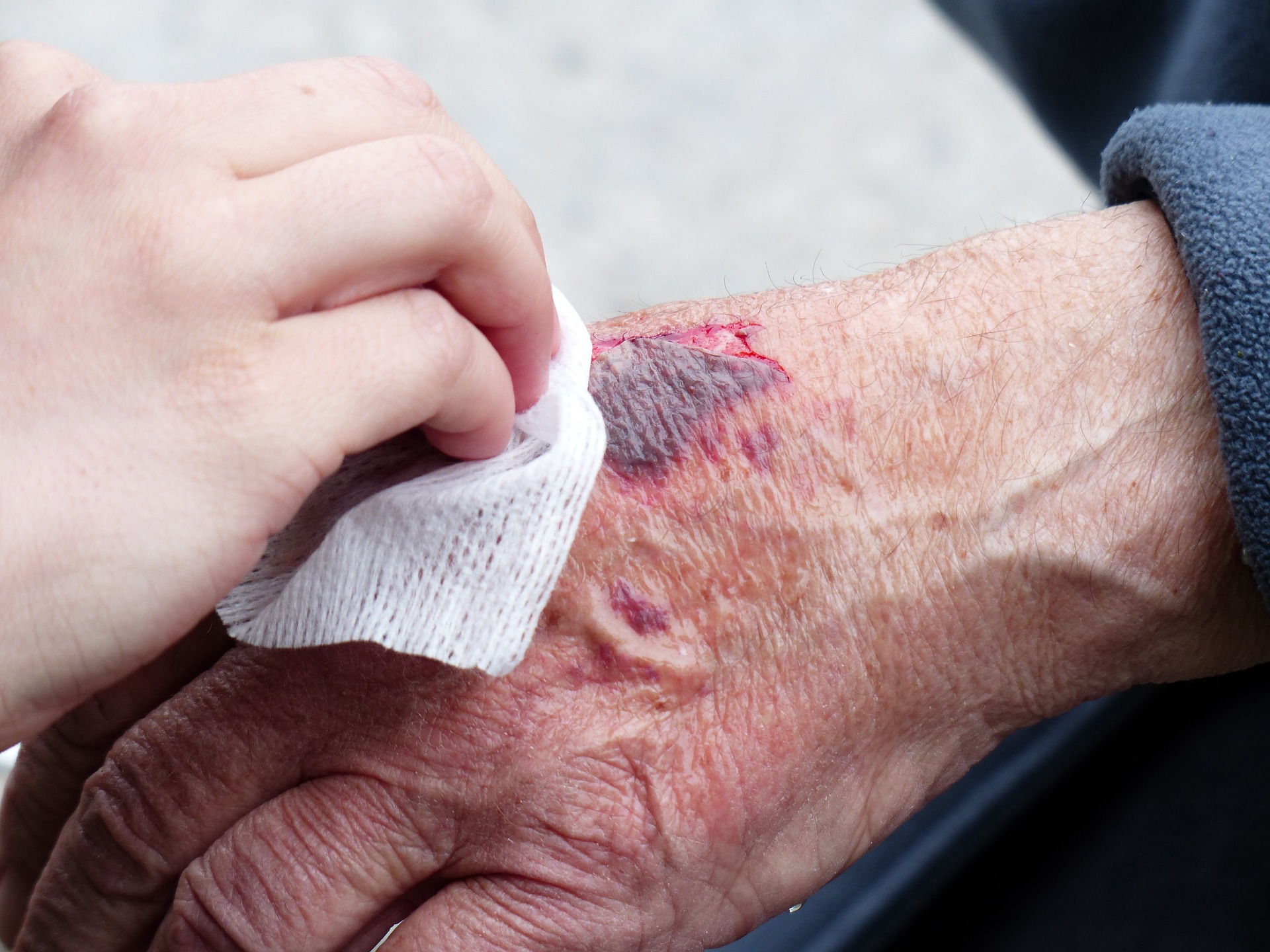 an injured hand being tended to