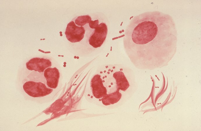 Gram stain showing gonorrhea-causing bacteria