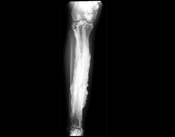 x-ray of bone with extra growths likened to dripping candle wax