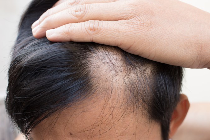 Person with black hair with a bald spot on their temple due to alopecia hair loss