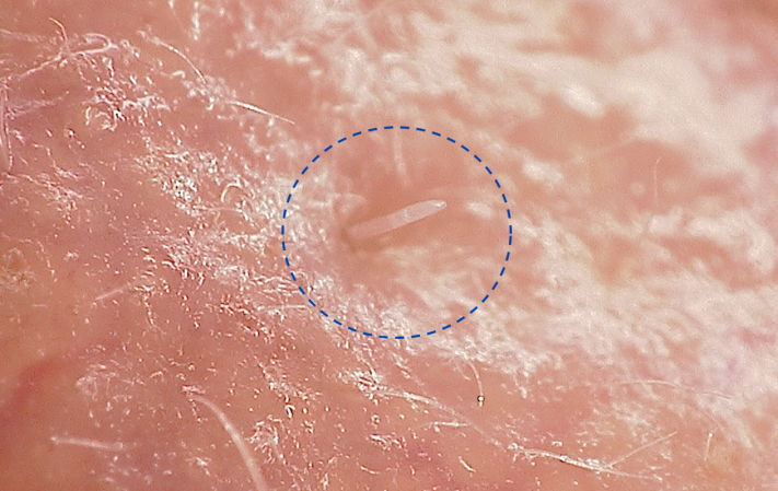 a close up of a face mite poking out of a skin pore