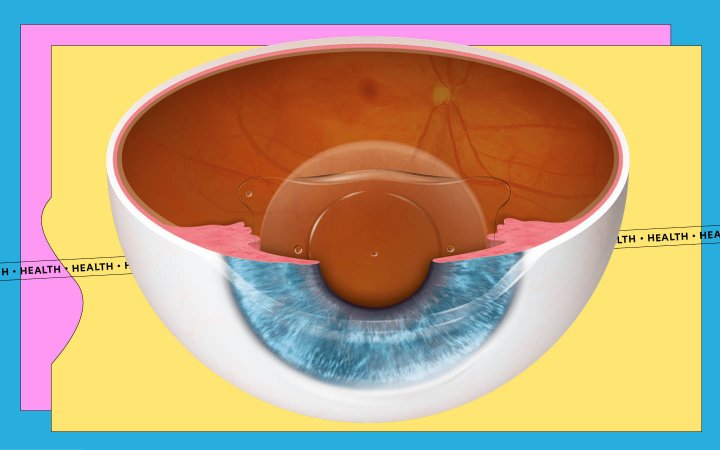  STAAR Surgical EVO permanent vision-correcting lenses in an eye diagram