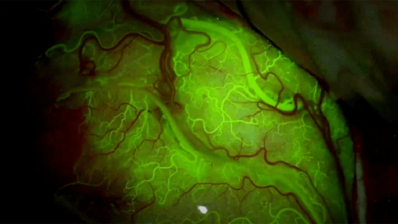 Fluorescent dye shown crossing the blood-brain barrier into the brain via sound waves.