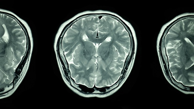 mri scan of the brain
