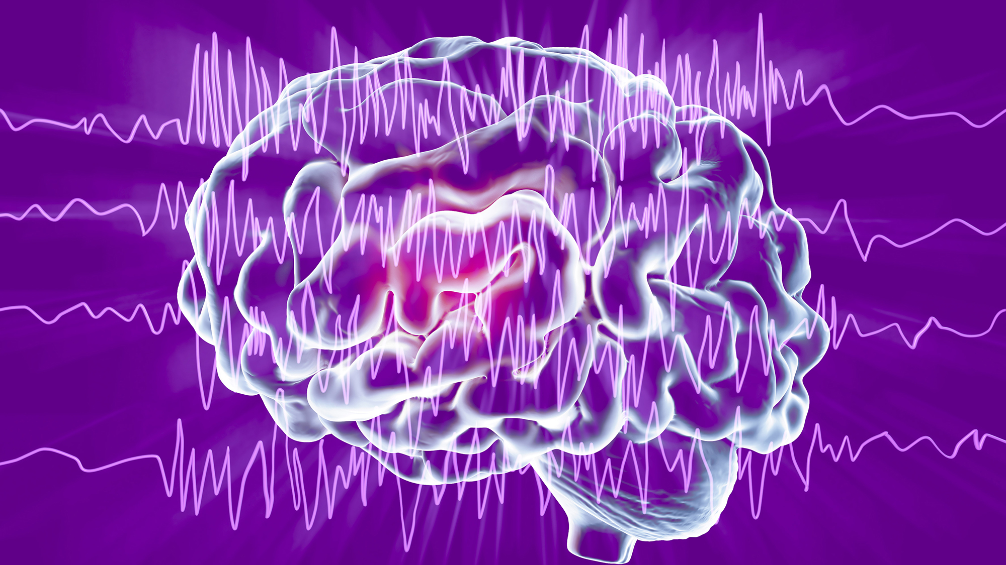 Brain and brain waves in epilepsy, computer illustration. This EEG (electroencephalogram) illustration shows generalized epilepsy, affecting the whole brain cortex: all the EEG traces show chaotic brain waves. Epilepsy can take many forms, and have different effects. This could illustrate both benign epilepsy (inherited childhood form that normally improves with age), and myoclonic epilepsy (form that causes muscle contractions). An EEG measures electrical activity in the brain using electrodes attached to the scalp.