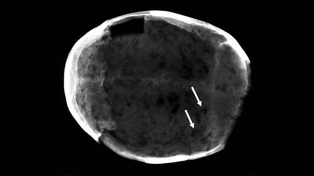 X-ray of skull pointing to region with evidence of cocaine use