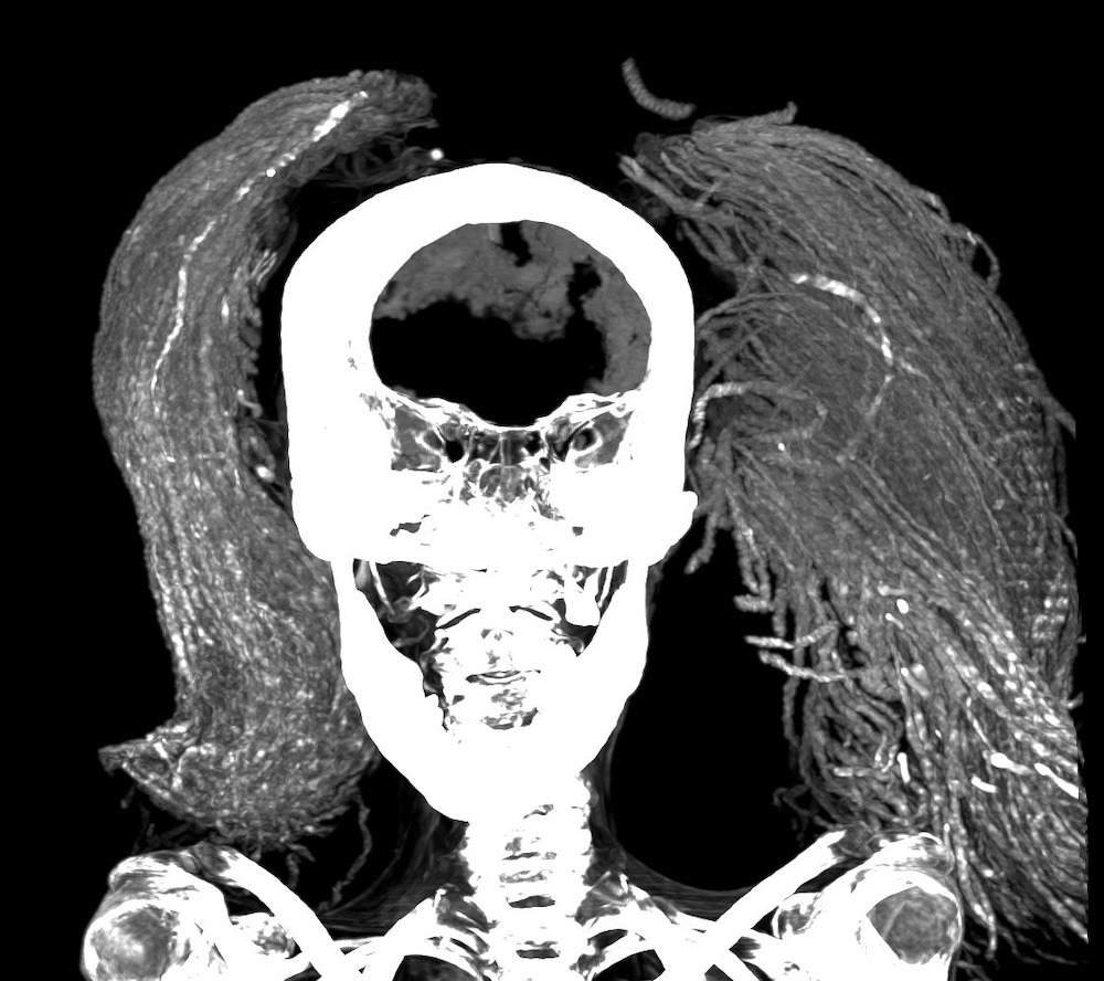 X-ray of screaming woman mummy